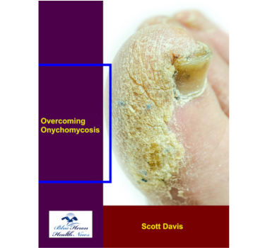 Overcoming Onychomycosis Reviews